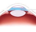 Trasplante corneal figura 9