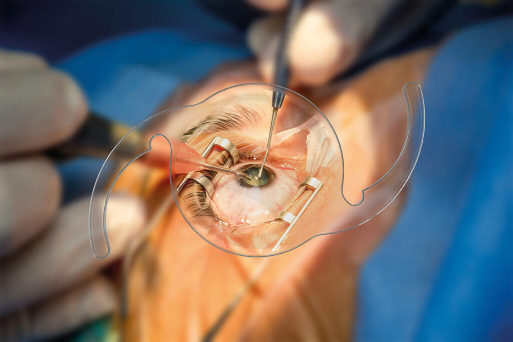 Cataratas y cirugía de lentes intraoculares